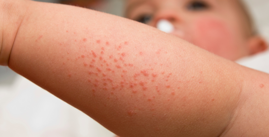child with a rash on arm